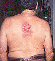 Skin cancer, before application, Feb. 1995