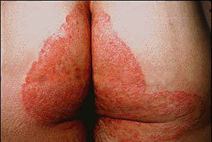 Jock Itch, buttocks area