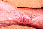 after treatment