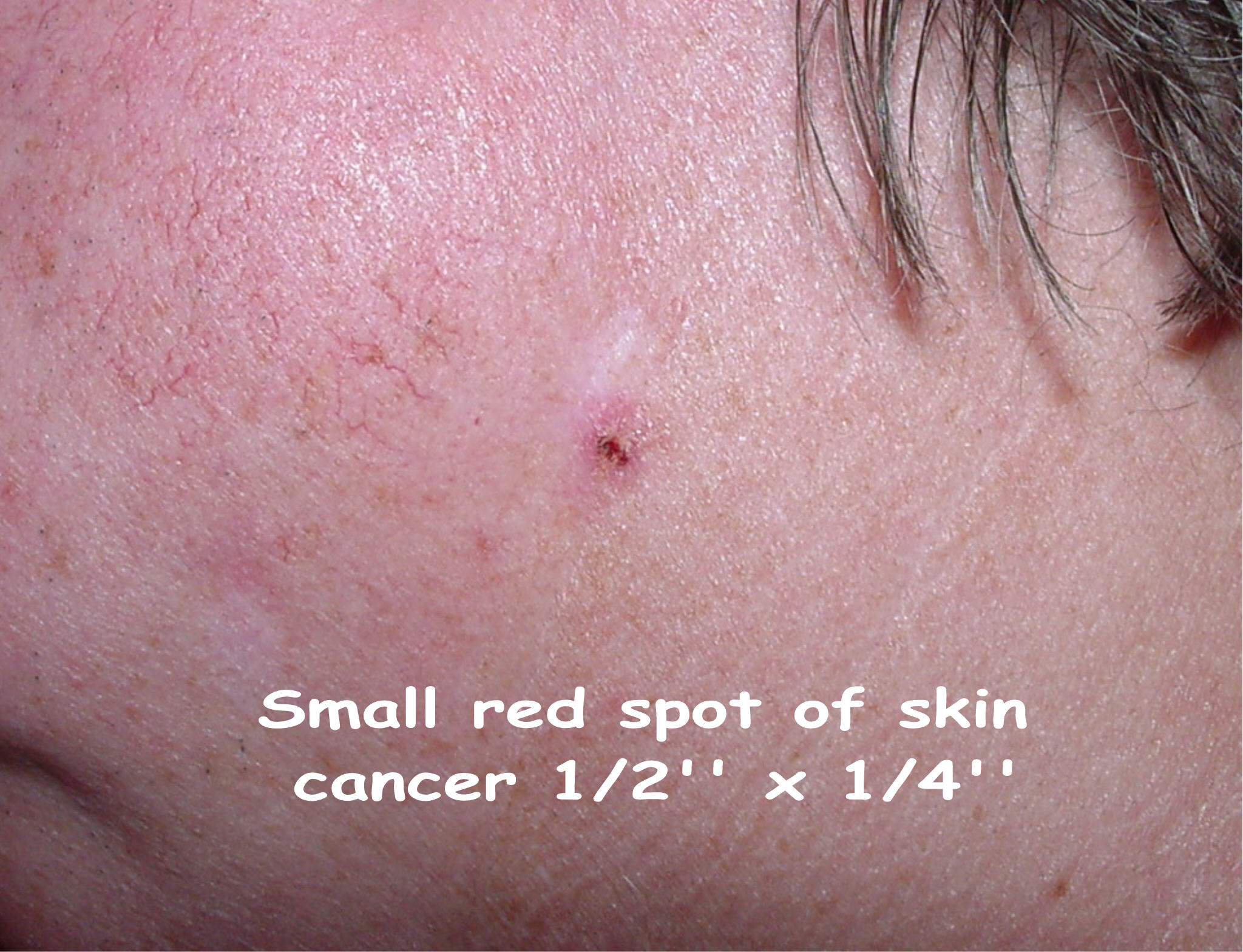 Who determines a spot is skin cancer?